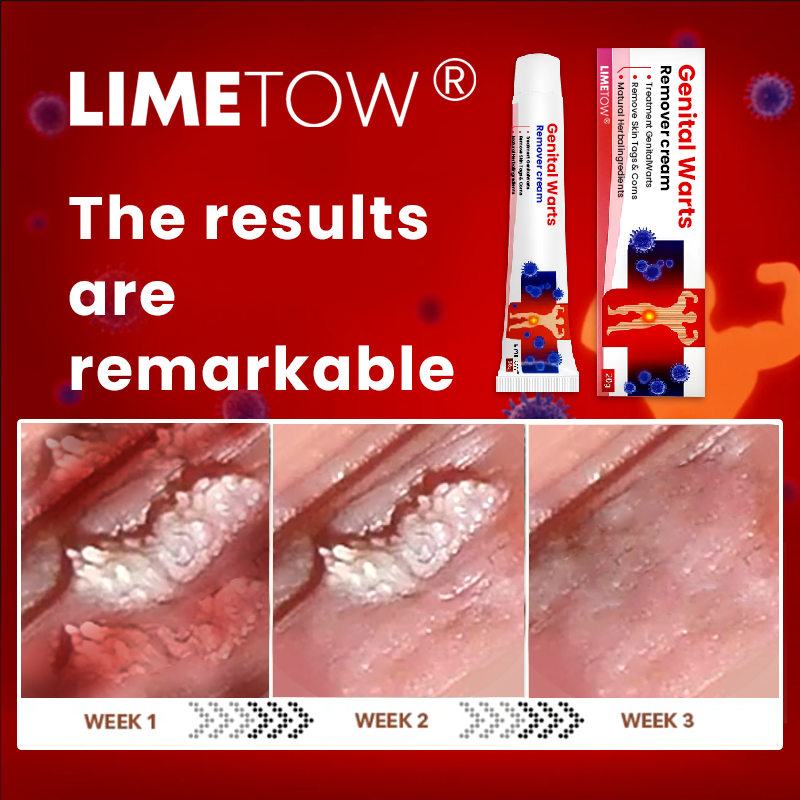 LIMETOW® Genital Warts Remover Cream