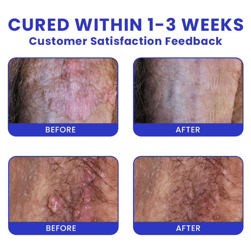 LIMETOW® Genital Warts Remover Cream