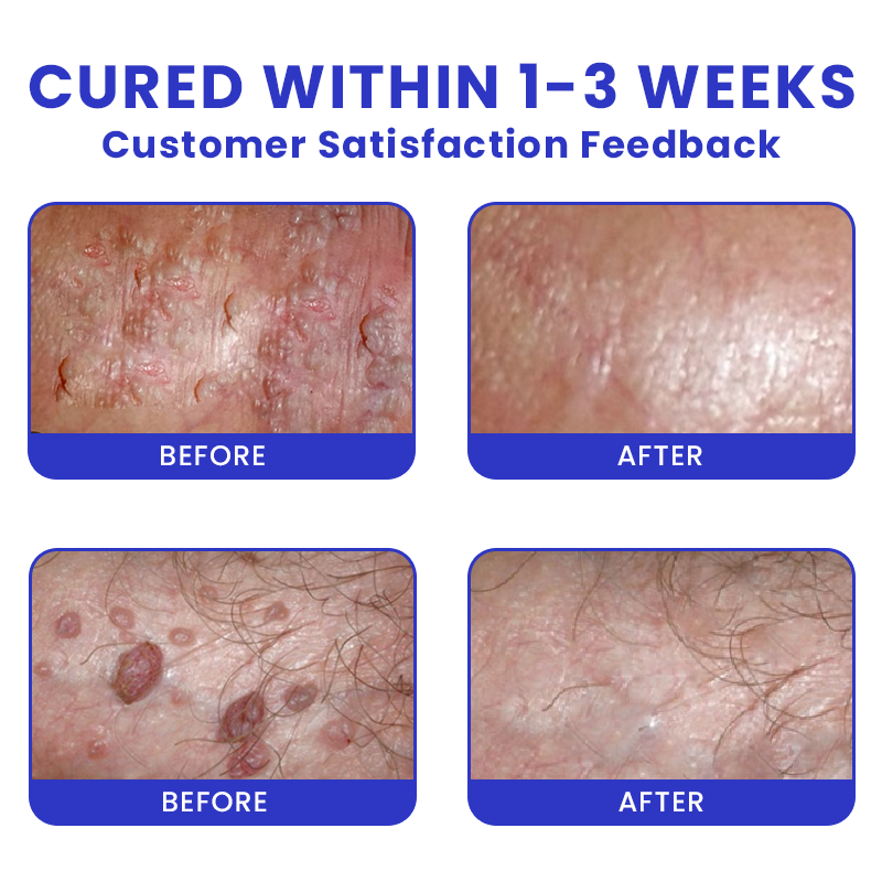 LIMETOW® Genital Warts Remover Cream