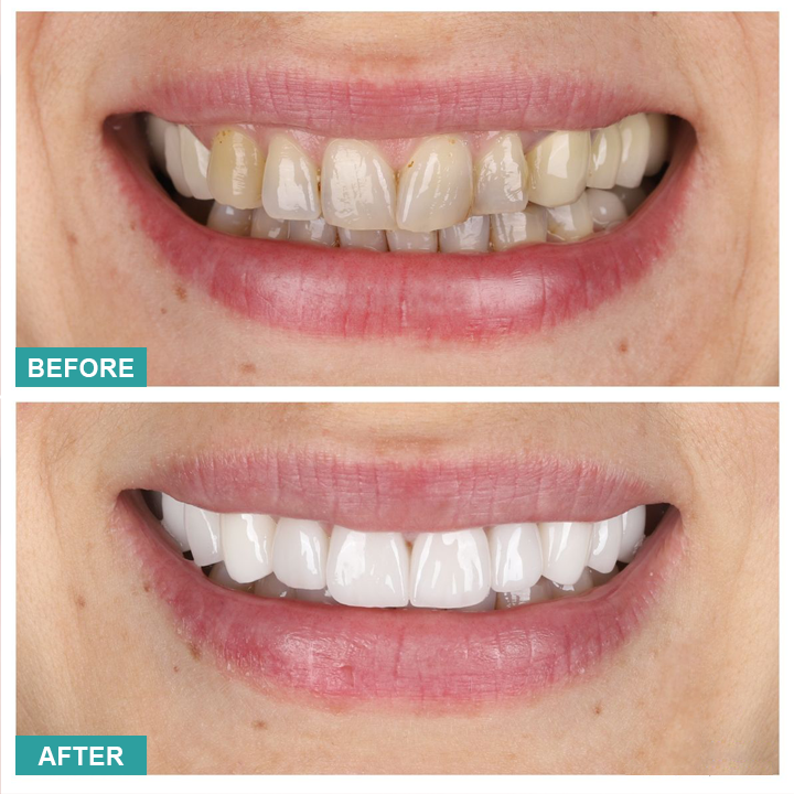 LIMETOW™ Instant Teeth Whitening Paint