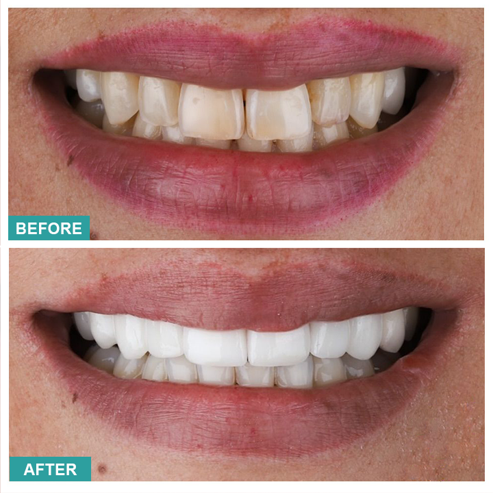 LIMETOW™ Instant Teeth Whitening Paint