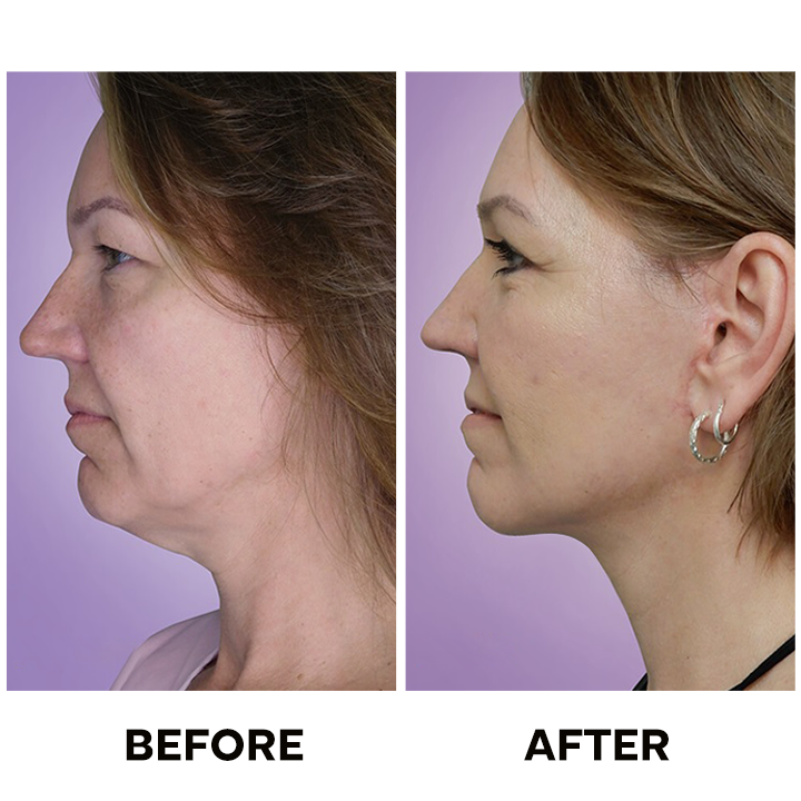 LIMETOW™ Tighten & Lift Neck Cream