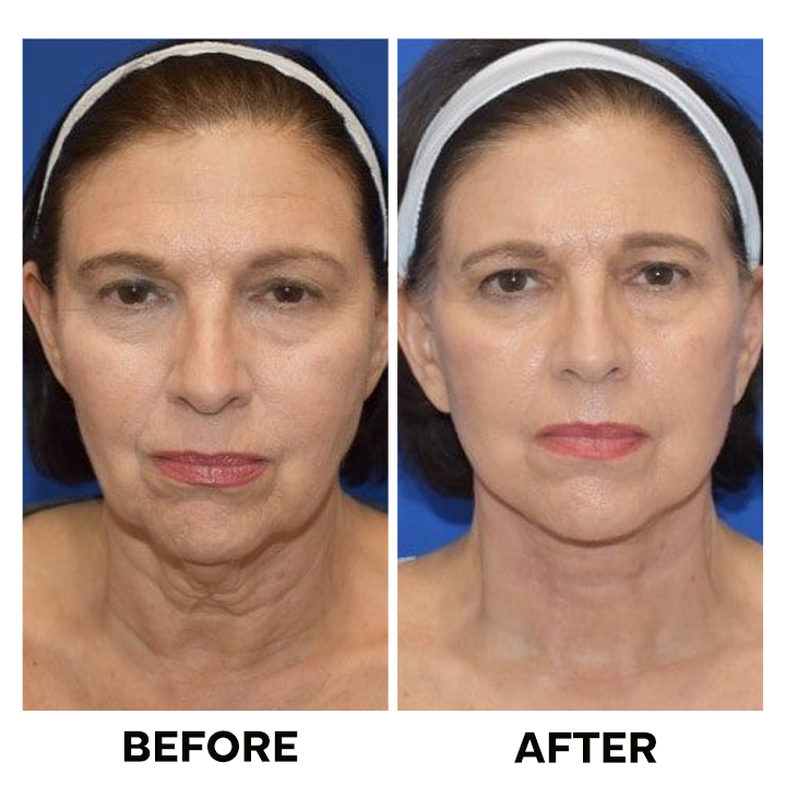 LIMETOW™ Tighten & Lift Neck Cream