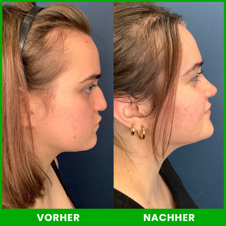 LIMETOW™ Nasenlift-Formungsöl