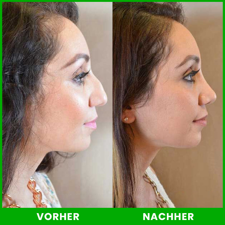 LIMETOW™ Nasenlift-Formungsöl