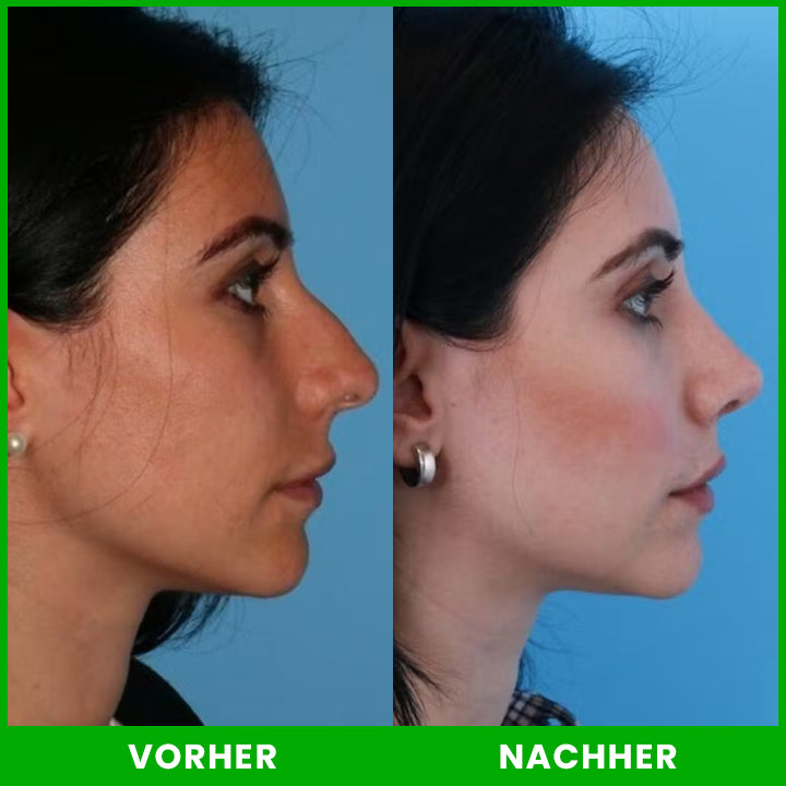 LIMETOW™ Nasenlift-Formungsöl