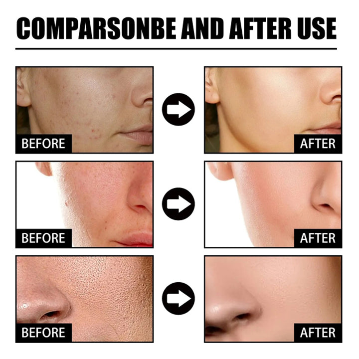 10% LIMETOW® Spots Removal Serum 🎉Second Item half price🎉