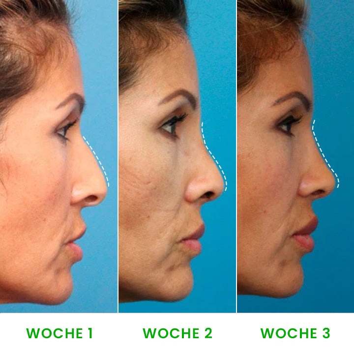 LIMETOW™ Nasenlift-Formungsöl