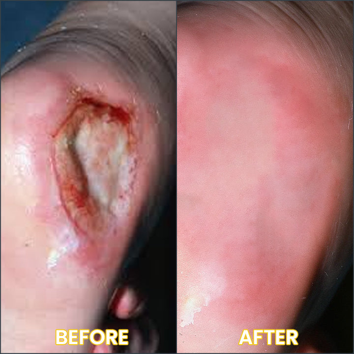 LIMETOW® Bedsore Cream
