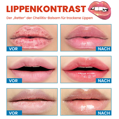 LIMETOW™ Cheilitis-Creme