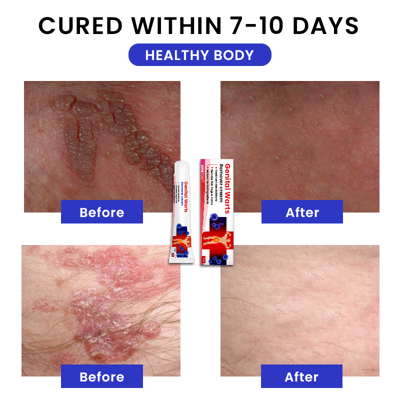 LIMETOW® Genital Warts Remover Cream