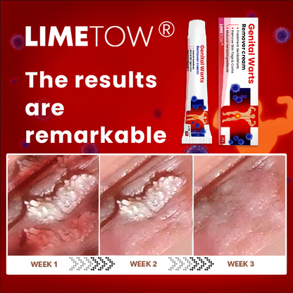 LIMETOW® Genital Warts Remover Cream