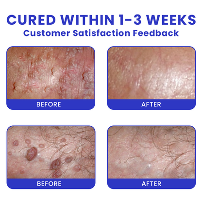 LIMETOW® Genital Warts Remover Cream