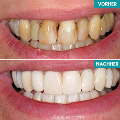LIMETOW™ Sofortige Zahnaufhellungsfarbe